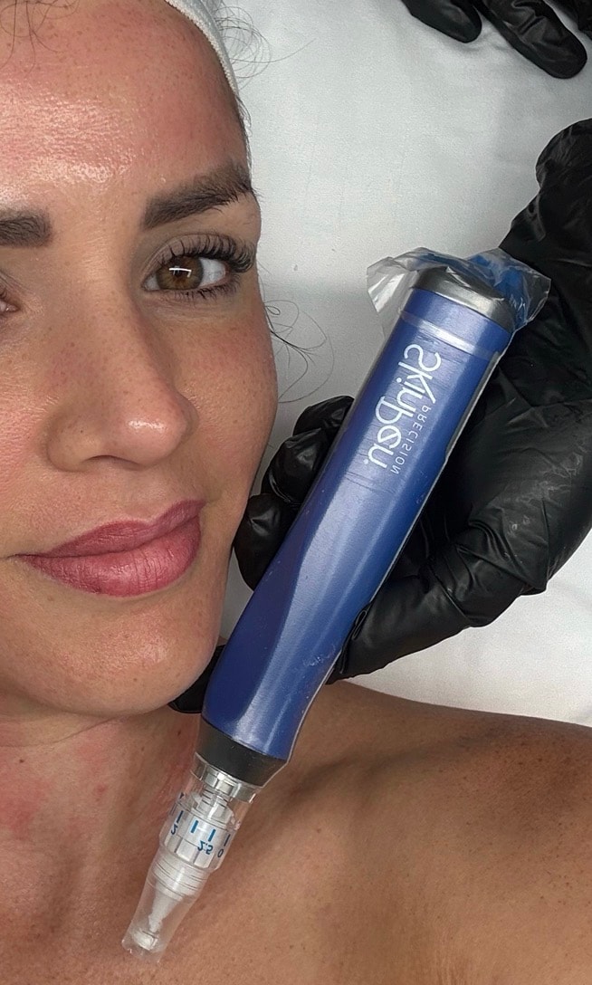 SkinPen Microneedling treatment
